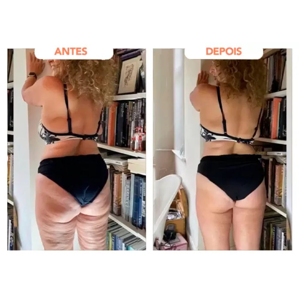 Antes e depois das costas e nádegas de uma mulher que usou o Trans Resveratrol Americano