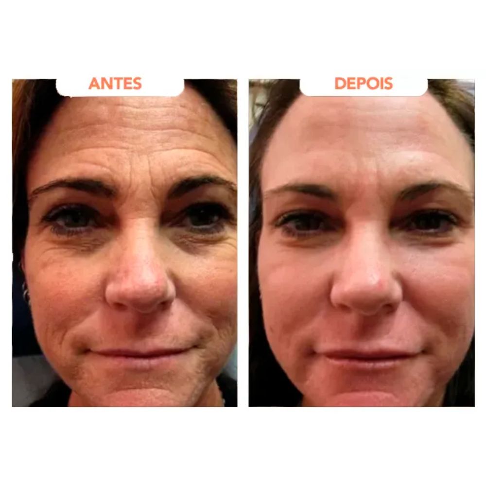 Antes e depois da parte frontal do rosto ao usar Trans Resveratrol Americano