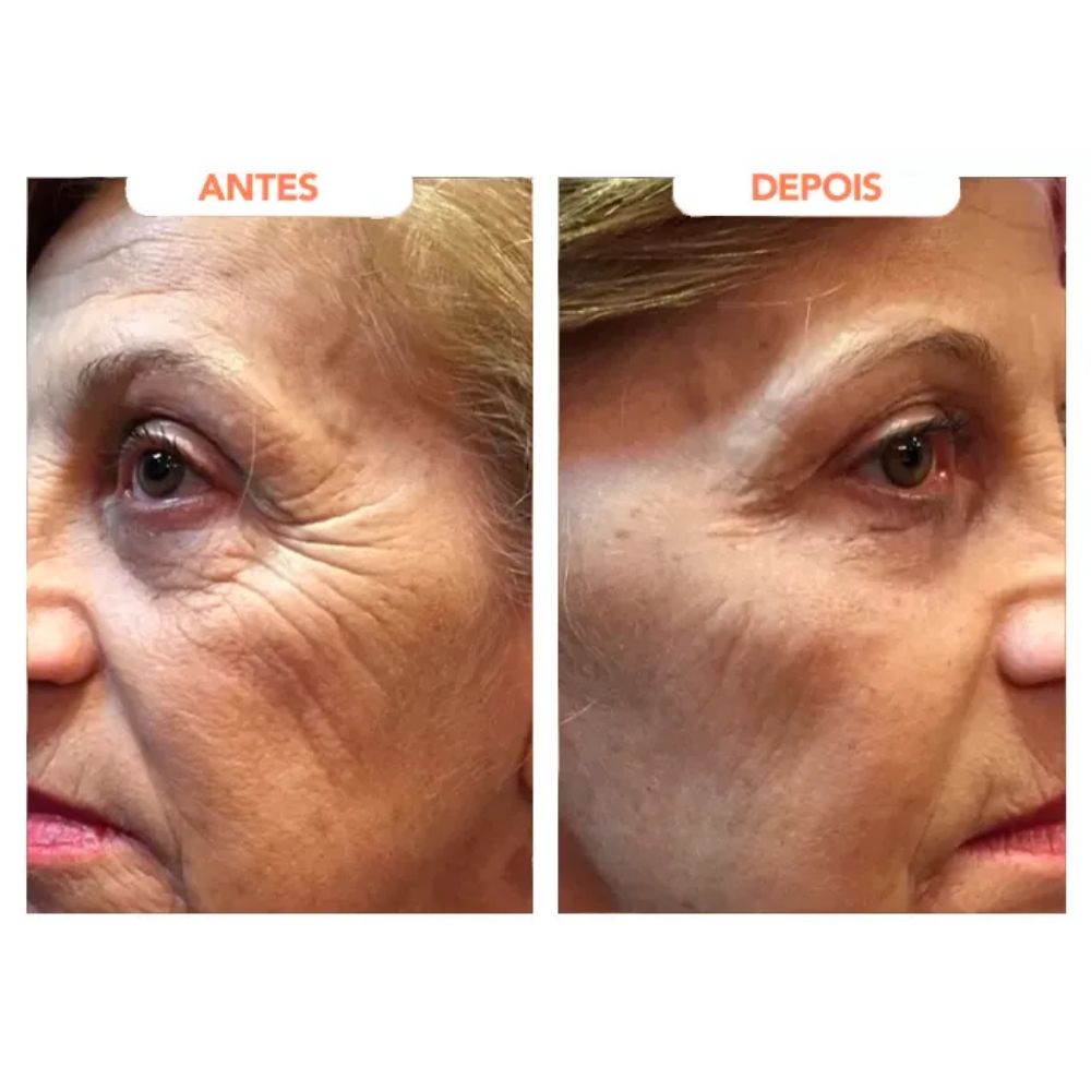 Antes e depois de uma mulher com menos rugas ao usar o Trans Resveratrol Americano