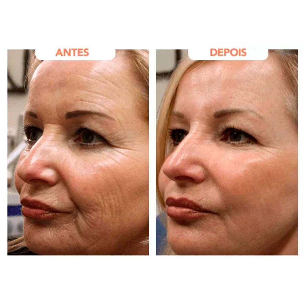 Antes e depois de um rosto feminino ao usar o Trans Resveratrol Americano