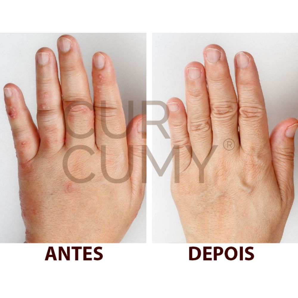 O Alívio e desinchaço para as mãos - antes e depois de quem utiliza Curcumy