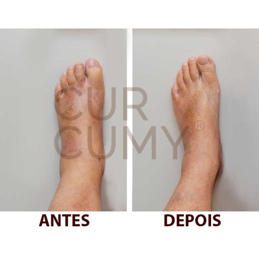 O Alívio e desinchaço para nos pés - antes e depois de quem utiliza Curcumy